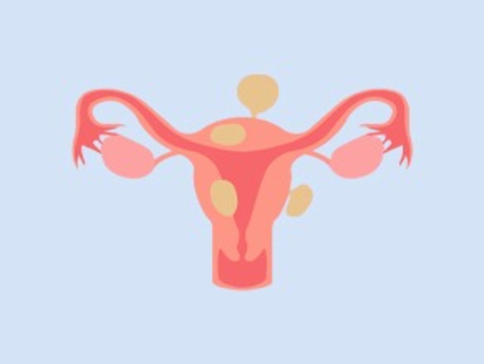 Fibroids
